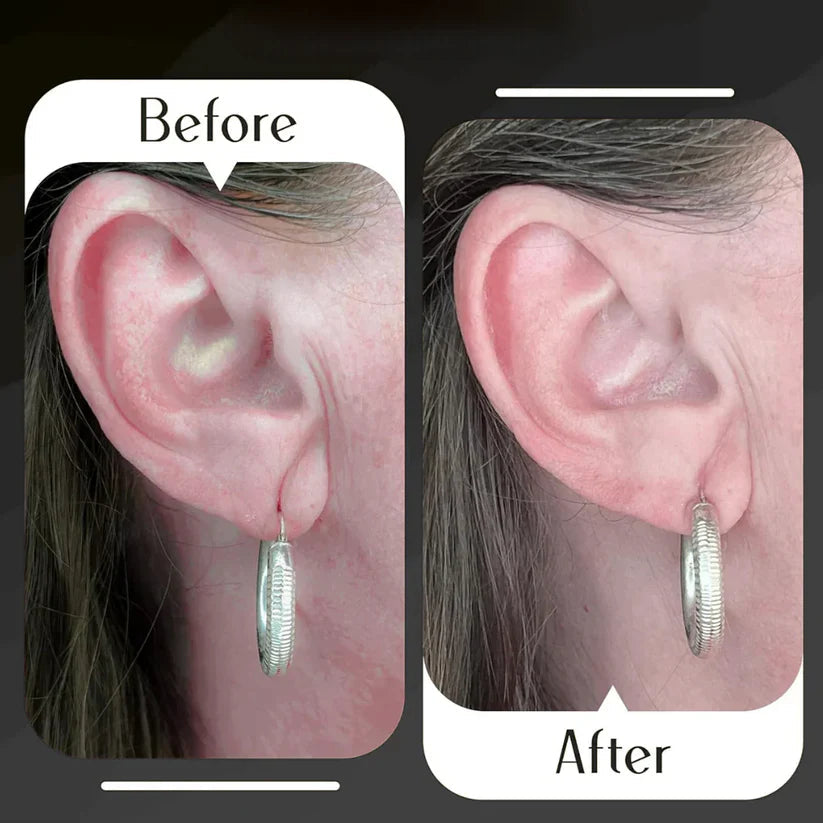 LobeLift™ Earlobe Support Patches (100 PCS)