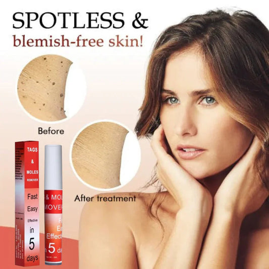 Tags & Moles Remover (BUY 1 GET 1 FREE) (1000+ Happy Customer)